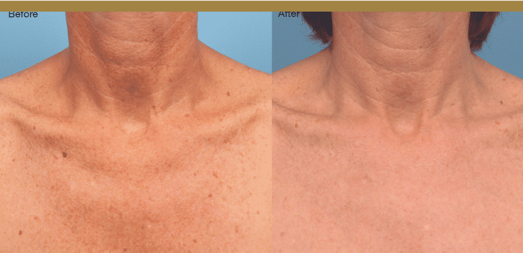 Reasons To Incorporate Intense Pulsed Light Therapy (IPL) Into Your