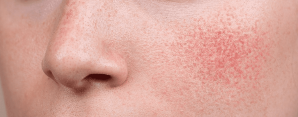 The Facts About Rosacea Treatment 649b53ec7afbf.png